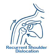 https://drpraneetorthogoa.com/wp-content/uploads/2026/04/Recurrent-Shoulder-Dislocation.png