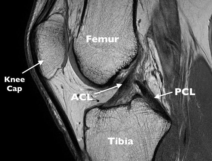ACL, Meniscus and Ligament Injuries in Athletes