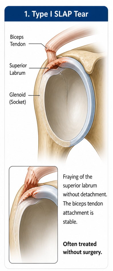 https://drpraneetorthogoa.com/wp-content/uploads/2026/05/1-Type-I-Slap-Tear.jpg
