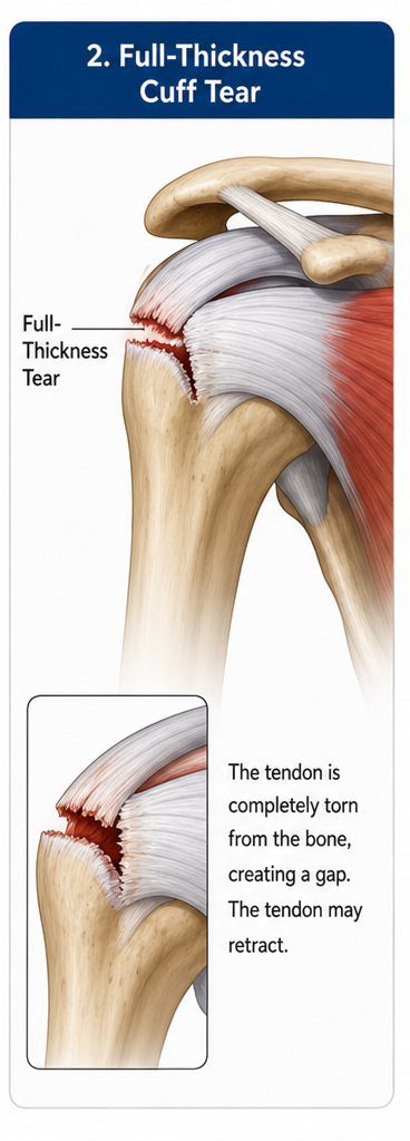 https://drpraneetorthogoa.com/wp-content/uploads/2026/05/Full-Thickness-Cuff-Tear.jpg